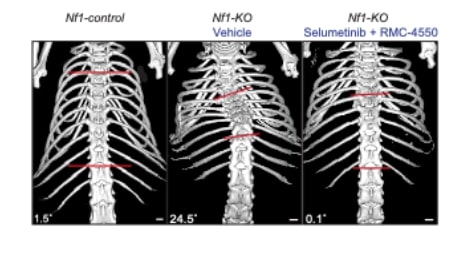 Blocking a Cancer-Related Pathway Helps Reduce Spine Deformities Due to Genetic Disorder, Finds New Study