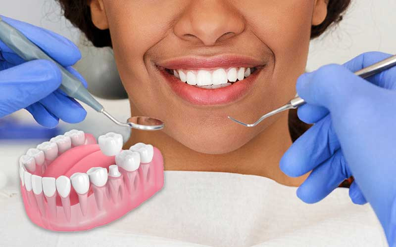 What Patients Should Know About Today’s Most Common Dental Crown Options